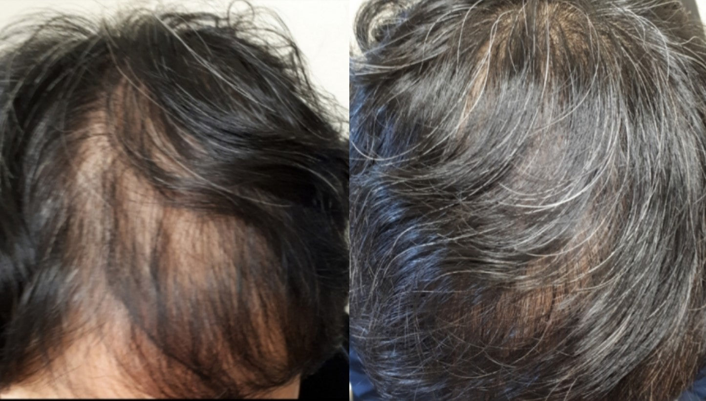 Best Hair Regrowth Treatment